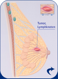 Tumor im Lymphknoten