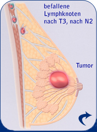 Brustkrebs T3 und N2